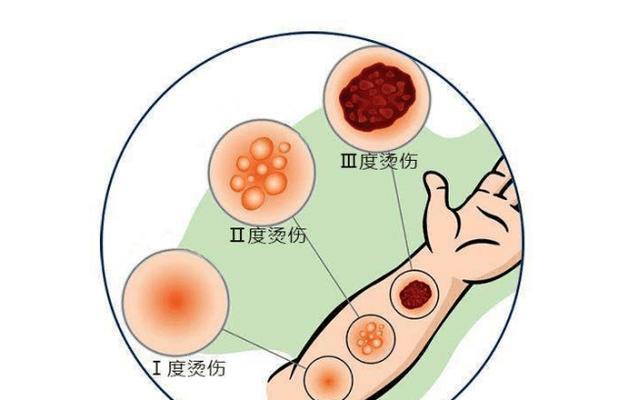 如何快速自救处理烫伤？（掌握烫伤自救技巧，保护自己安全无忧）