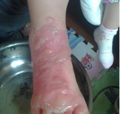 如何快速自救处理烫伤？（掌握烫伤自救技巧，保护自己安全无忧）