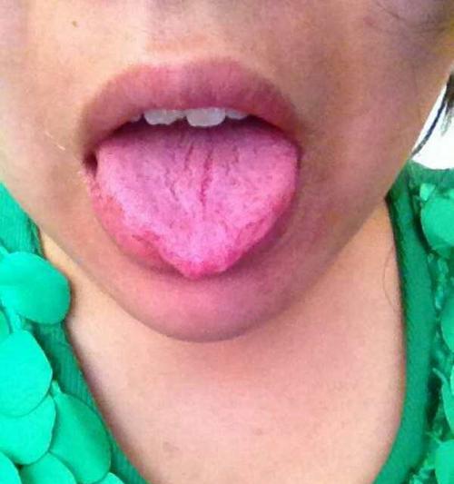 舌头裂纹的原因及预防方法（了解舌头裂纹的原因）