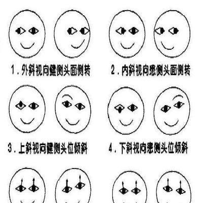 深入探讨导致斜视的原因（解析斜视发生的关键因素及防治方法）