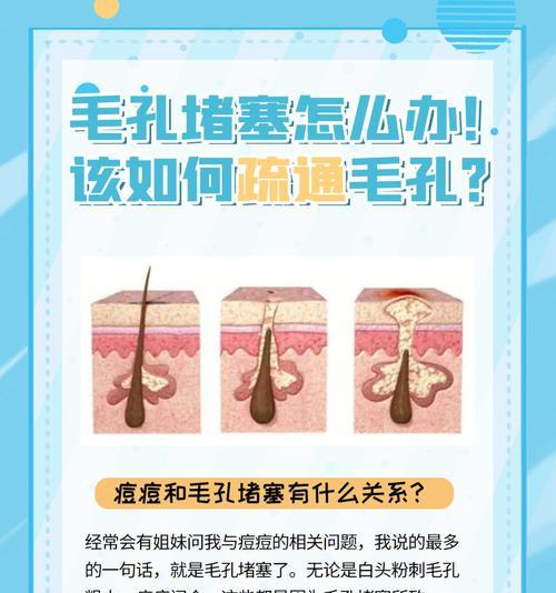 毛孔严重堵塞怎么办呢？有效清理毛孔堵塞的方法有哪些？